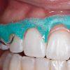 Thumbnail Opaldam Green - Barrera Gingival0
