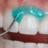 Thumbnail Opaldam Green - Barrera Gingival0